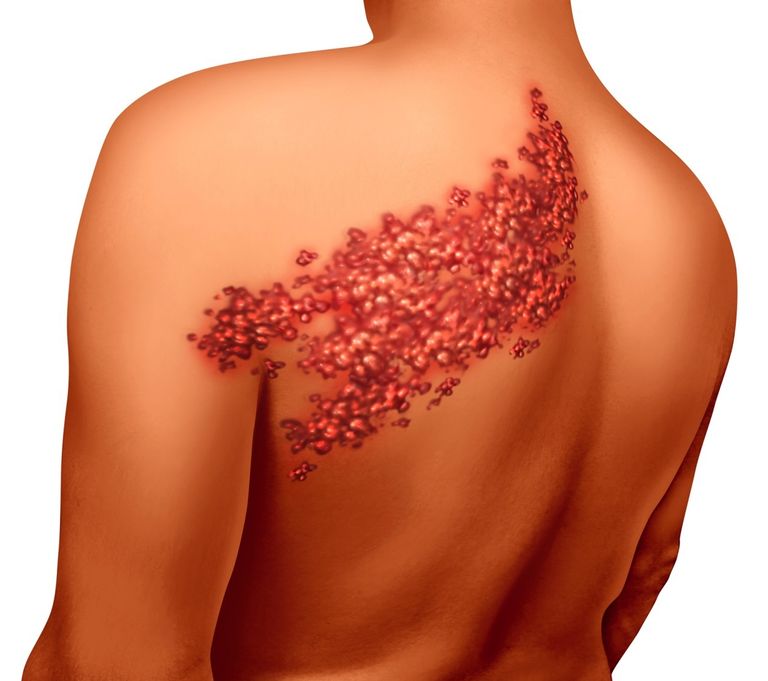 133-222449-shingles-disease-causes-symptoms-treatment-methods-2 دور التردد الحراري في علاج آلام المفاصل والعمود الفقري
