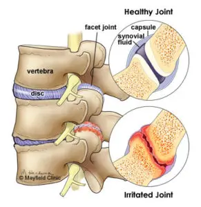 Facet-Joint-Arthritis حقن الستيرويدات لعلاج آلام العمود الفقري: متى تحتاجها؟