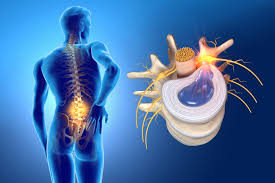 Herniated-Disc حقن الستيرويدات لعلاج آلام العمود الفقري: متى تحتاجها؟