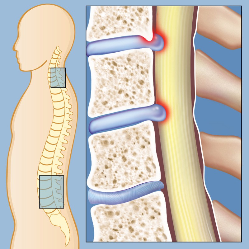 Spinal-Stenosis-1 حقن الستيرويدات لعلاج آلام العمود الفقري: متى تحتاجها؟