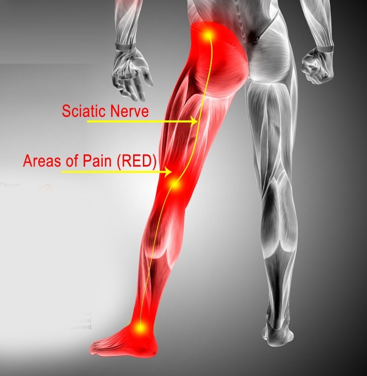 sciatica حقن الستيرويدات لعلاج آلام العمود الفقري: متى تحتاجها؟