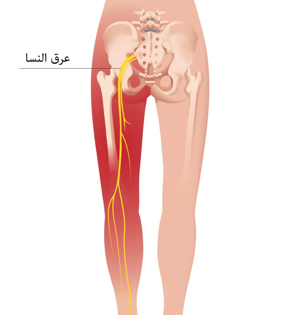 عرق-النسا-974x1024 دور التردد الحراري في علاج آلام المفاصل والعمود الفقري